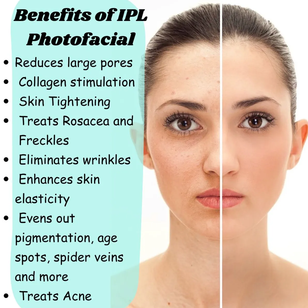 Clear, even-toned skin after IPL photo facial treatment at Lavish Aesthetique Clinic, Ahmedabad